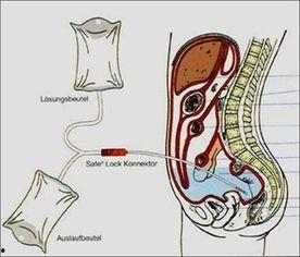 肛交灌肠无码片磁力